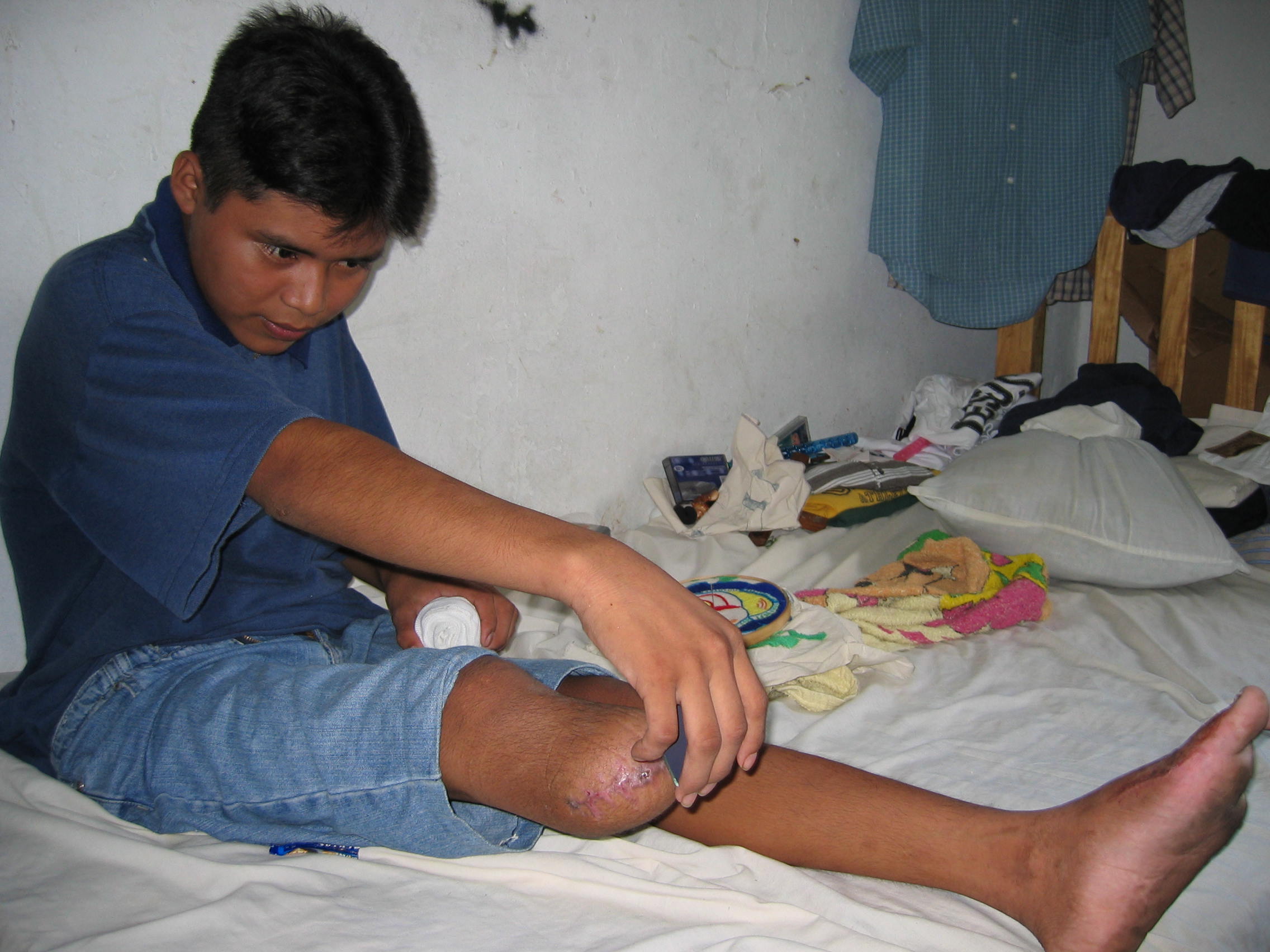 Hugo Tambrís Sióp, 14, checks how well his wounds are healing with the help of a mirror. He lost part of his right leg and three toes on his left foot.